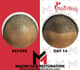 Slider image (10) MAXIM Hair Restoration Turkey